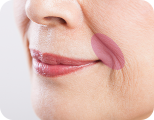 Face and Neck Lifting in LABOM Plastic Surgery in Seoul, Korea