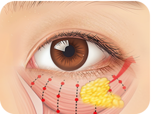 Face and Neck Lifting in LABOM Plastic Surgery in Seoul, Korea