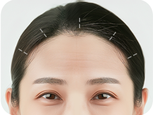 Endoscopic Brow Lift at LABOM Plastic Surgery in Seoul, Korea