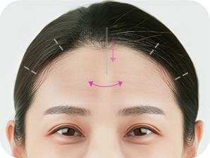 Endoscopic Brow Lift at LABOM Plastic Surgery in Seoul, Korea
