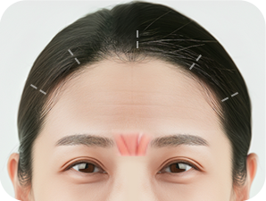 Endoscopic Brow Lift at LABOM Plastic Surgery in Seoul, Korea