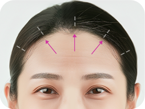 Endoscopic Brow Lift at LABOM Plastic Surgery in Seoul, Korea