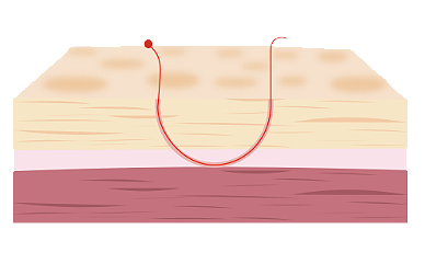 Endoscopic Brow Lift at LABOM Plastic Surgery in Seoul, Korea