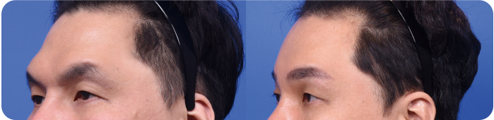 Endoscopic Brow Lift at LABOM Plastic Surgery in Seoul, Korea