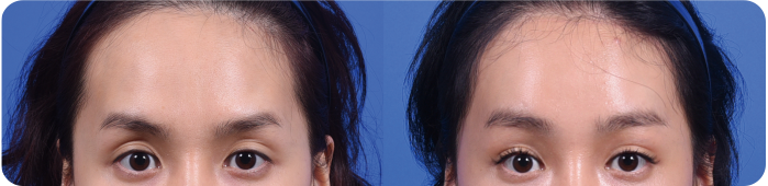 Endoscopic Brow Lift at LABOM Plastic Surgery in Seoul, Korea