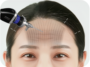 Forehead Lift Revision in Korea at LABOM Plastic Surgery in Seoul