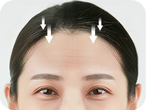 Forehead Lift Revision in Korea at LABOM Plastic Surgery in Seoul
