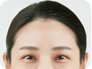 Forehead Lift Revision in Korea at LABOM Plastic Surgery in Seoul
