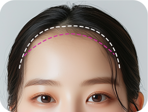 Forehead Reduction in Korea at LABOM Plastic Surgery in Seoul