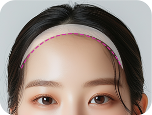 Forehead Reduction in Korea at LABOM Plastic Surgery in Seoul