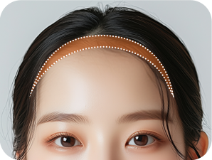 Forehead Reduction in Korea at LABOM Plastic Surgery in Seoul