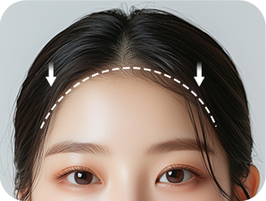 Forehead Reduction in Korea at LABOM Plastic Surgery in Seoul