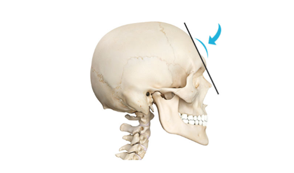 Brow Bone Reduction in Korea at LABOM Plastic Surgery in Seoul