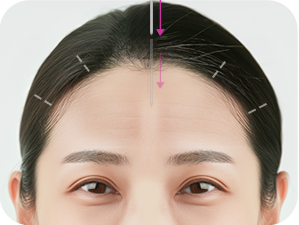Brow Bone Reduction in Korea at LABOM Plastic Surgery in Seoul