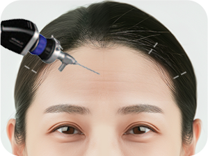 Brow Bone Reduction in Korea at LABOM Plastic Surgery in Seoul