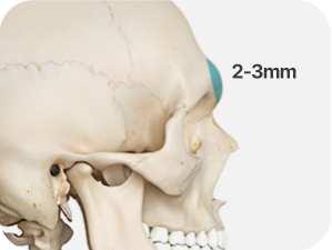 Brow Bone Reduction in Korea at LABOM Plastic Surgery in Seoul