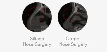 Non-surgical CarGel Rhinoplasty in Korea at LABOM Plastic Surgery in Seoul