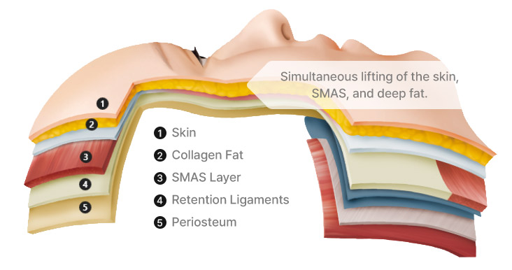 Face and Neck Lifting in LABOM Plastic Surgery in Seoul, Korea