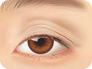 Upper Blepharoplasty in Korea at LABOM Plastic Surgery in Seoul