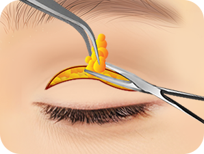 Upper Blepharoplasty in Korea at LABOM Plastic Surgery in Seoul