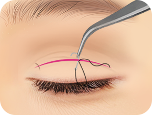 Upper Blepharoplasty in Korea at LABOM Plastic Surgery in Seoul