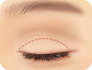 Upper Blepharoplasty in Korea at LABOM Plastic Surgery in Seoul