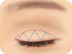 Upper Blepharoplasty in Korea at LABOM Plastic Surgery in Seoul