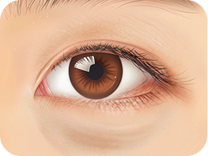 Lower Blepharoplasty in Korea at LABOM Plastic Surgery in Seoul
