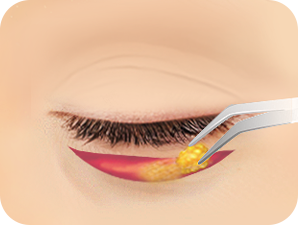 Lower Blepharoplasty in Korea at LABOM Plastic Surgery in Seoul