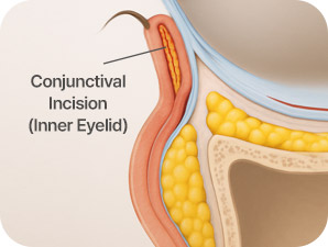 Under-eye Fat Repositioning in Korea at LABOM Plastic Surgery in Seoul