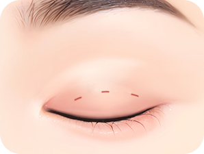 Double Eyelid Surgery in Korea at LABOM Plastic Surgery in Seoul