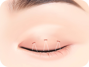 Double Eyelid Surgery in Korea at LABOM Plastic Surgery in Seoul