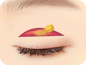 Double Eyelid Surgery in Korea at LABOM Plastic Surgery in Seoul
