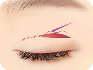 Double Eyelid Surgery in Korea at LABOM Plastic Surgery in Seoul