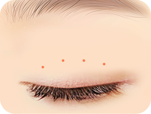 Double Eyelid Surgery in Korea at LABOM Plastic Surgery in Seoul