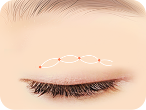 Double Eyelid Surgery in Korea at LABOM Plastic Surgery in Seoul