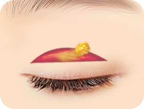 Ptosis Correction in Korea at LABOM Plastic Surgery in Seoul