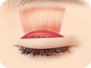 Ptosis Correction in Korea at LABOM Plastic Surgery in Seoul