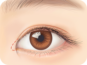 Canthoplasty in Korea at LABOM Plastic Surgery in Seoul