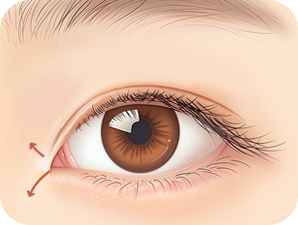 Canthoplasty in Korea at LABOM Plastic Surgery in Seoul