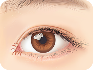 Canthoplasty in Korea at LABOM Plastic Surgery in Seoul