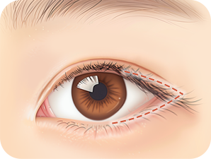 Canthoplasty in Korea at LABOM Plastic Surgery in Seoul