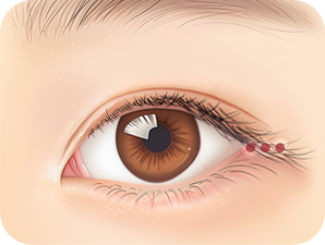 Canthoplasty in Korea at LABOM Plastic Surgery in Seoul