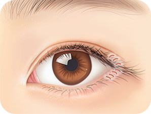 Canthoplasty in Korea at LABOM Plastic Surgery in Seoul