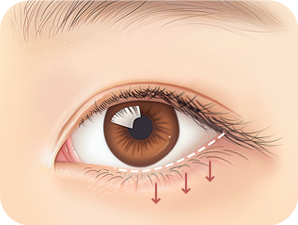 Canthoplasty in Korea at LABOM Plastic Surgery in Seoul