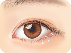 Canthoplasty in Korea at LABOM Plastic Surgery in Seoul