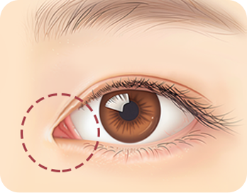 Canthoplasty Revision in Korea at LABOM Plastic Surgery in Seoul