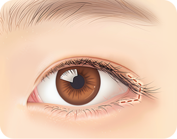 Canthoplasty Revision in Korea at LABOM Plastic Surgery in Seoul