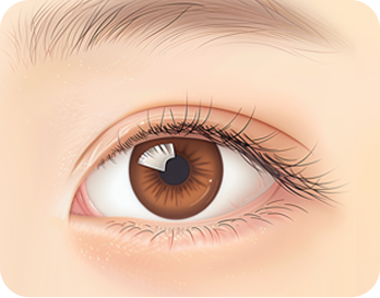 Canthoplasty Revision in Korea at LABOM Plastic Surgery in Seoul