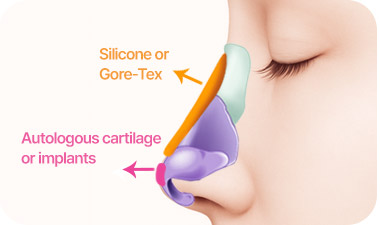 Rhinoplasty in Korea at LABOM Plastic Surgery in Seoul
